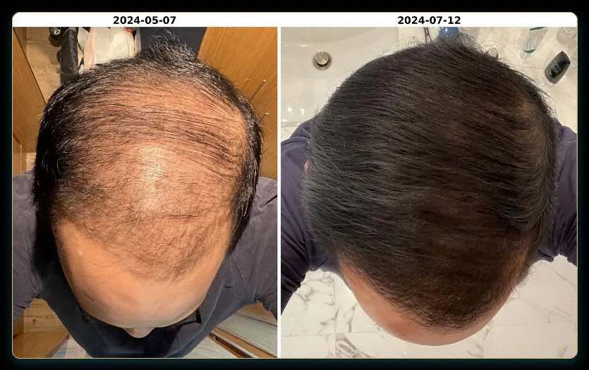 Scalp before and after, May to July 2024
