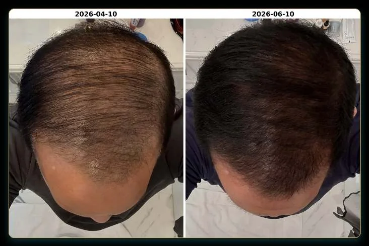 Scalp before and after, April to June 2026