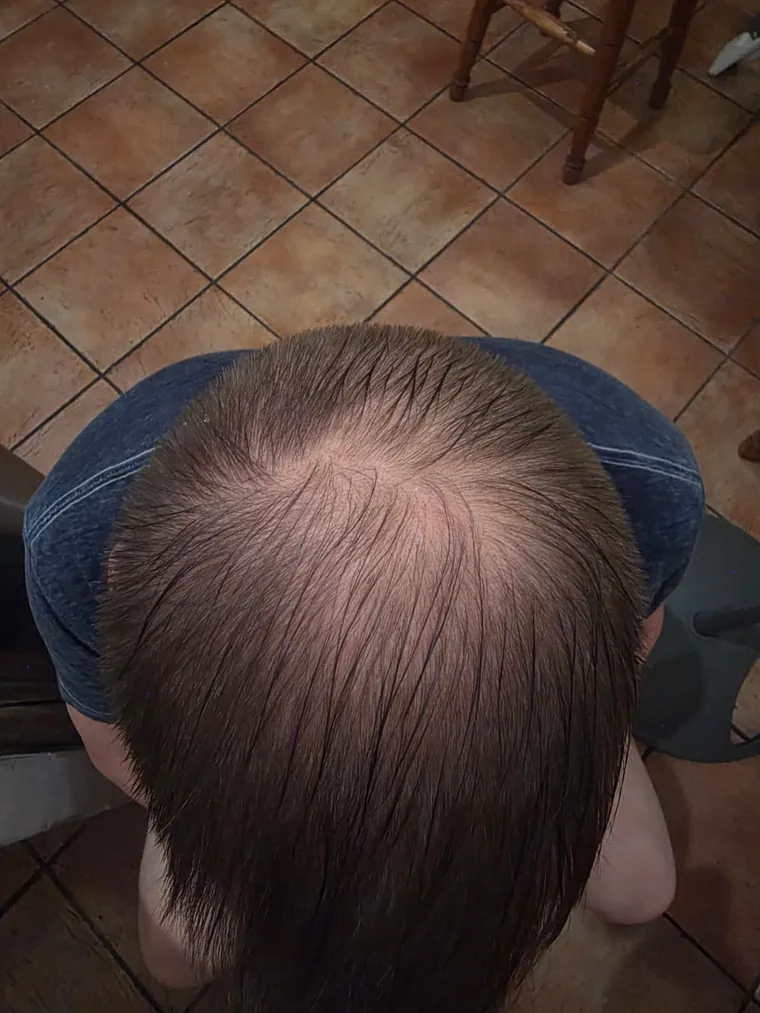 Scalp after, 23 July 2026