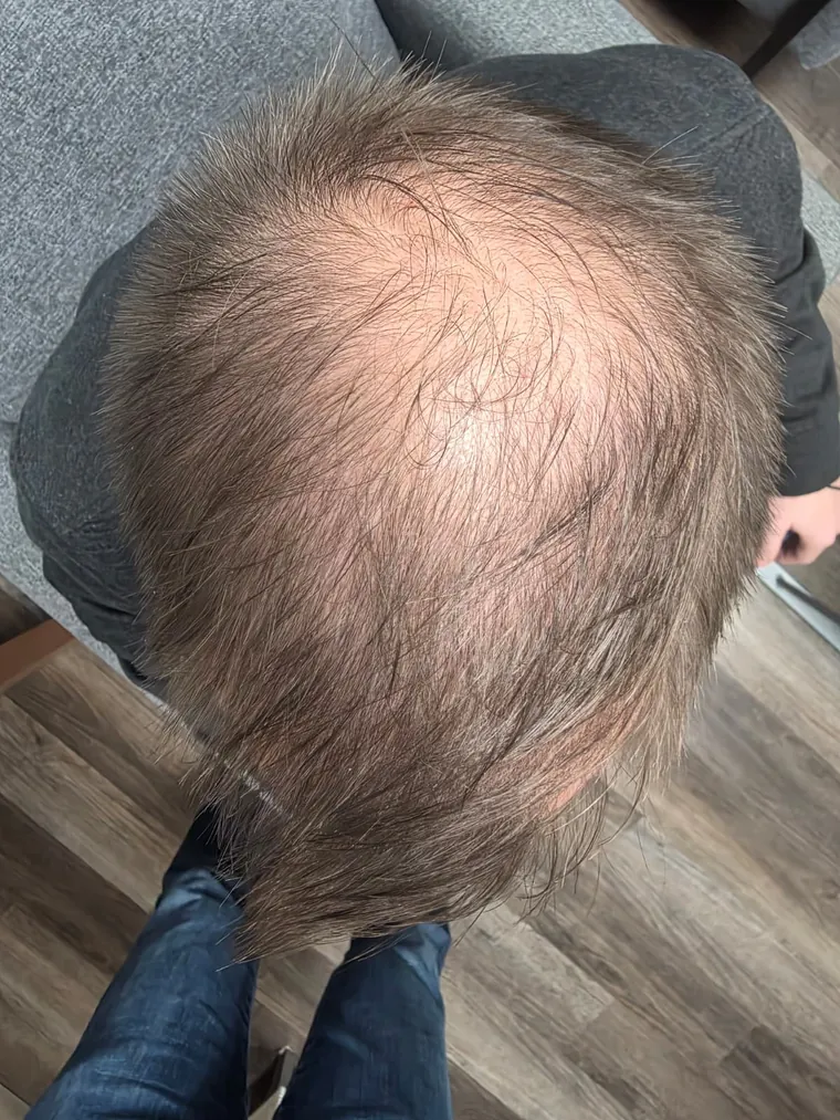 Scalp before, 23 June 2026