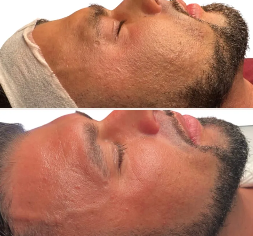 Facial profile before and after